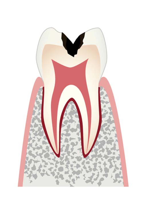 C2の内部まで進行した虫歯