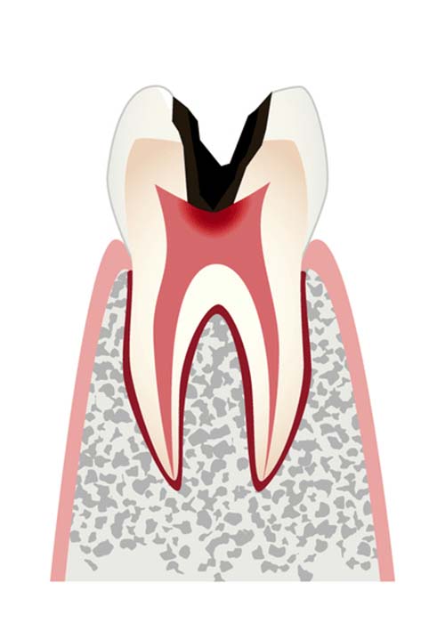C3の神経に達した虫歯