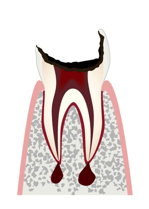 C4の虫歯で歯が残せない状態