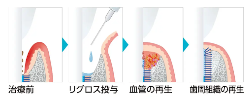 リグロスの仕組み