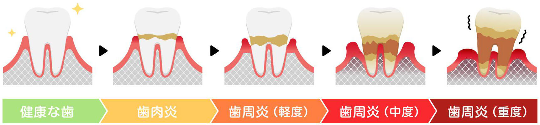 歯周病の進行段階・治療