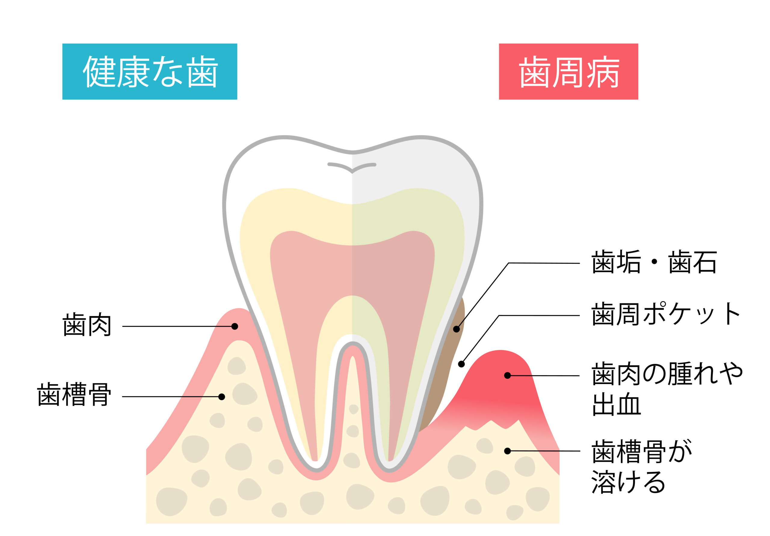 【セルフチェック付】当てはまったら危険！歯周病の症状5選
