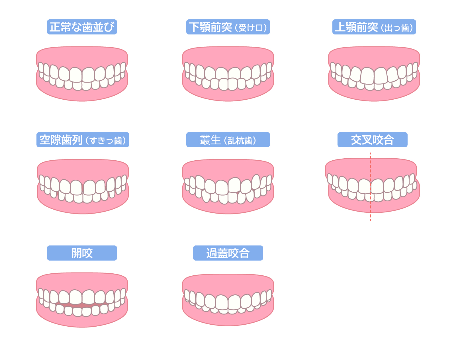 小児矯正を始めるべきタイミング