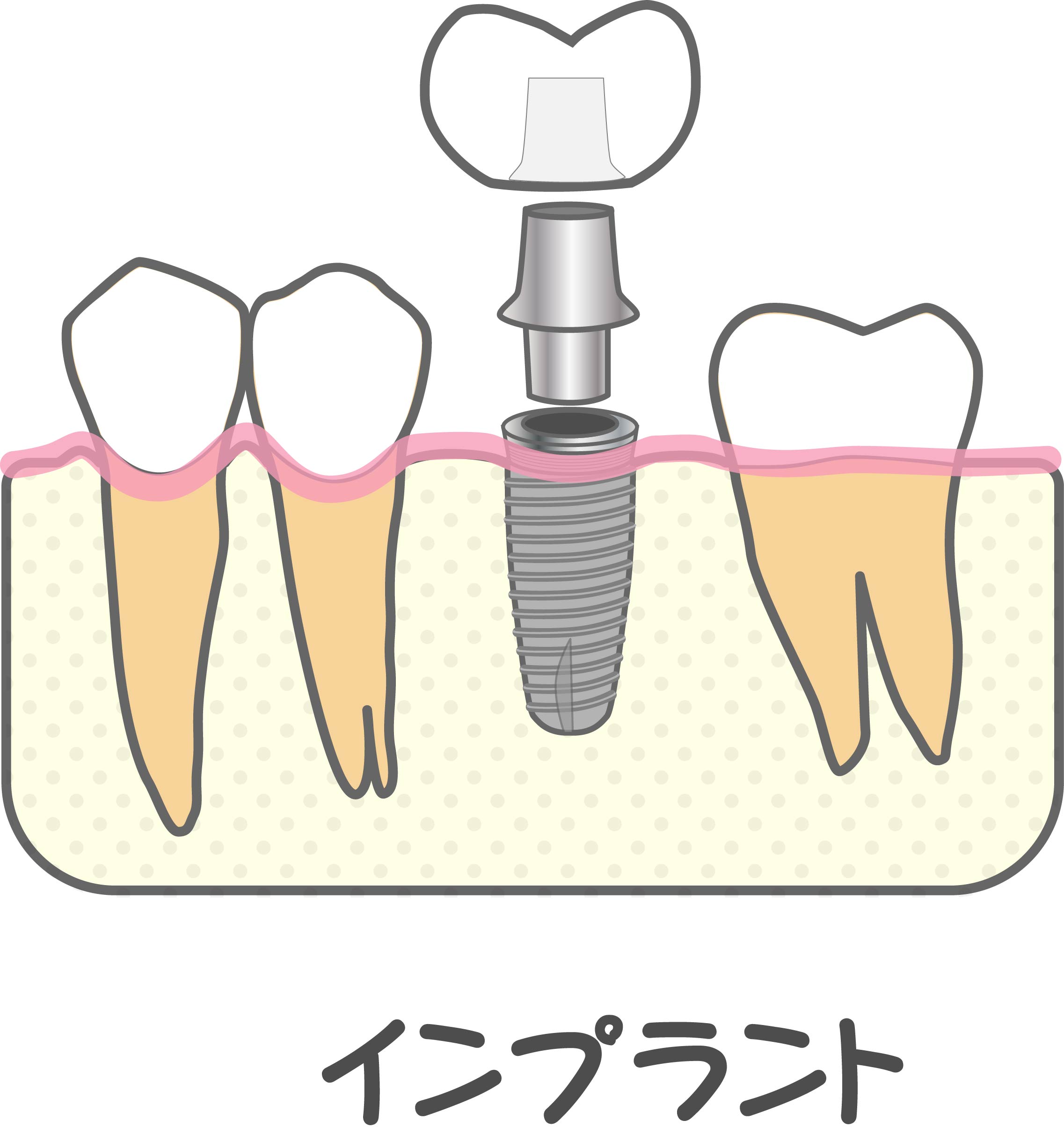 インプラントのよくあるトラブル かぶせものがとれる